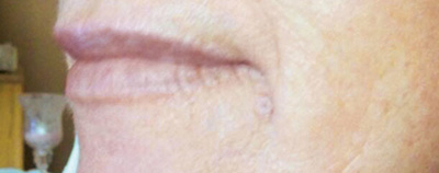 Entfernung von Hautanhängseln nachher