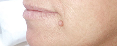 Entfernung von Hautanhängseln vorher