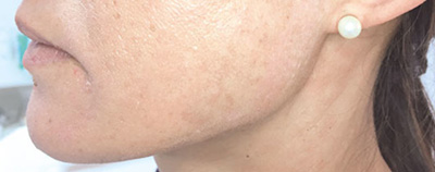 Entfernung von Pigmentflecken nachher