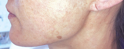 Entfernung von Pigmentflecken vorher