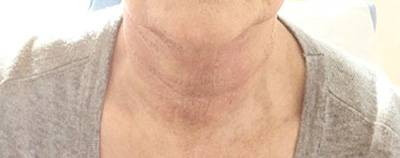 Halsstraffung nachher