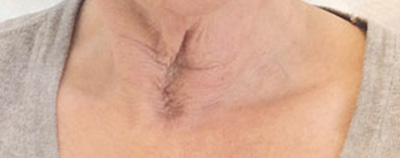 Halsstraffung vorher