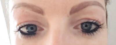 Oberlidstraffung nachher