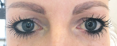 Oberlidstraffung vorher