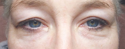 Oberlidstraffung vorher