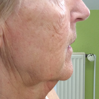 Seiten- und Halslift nachher