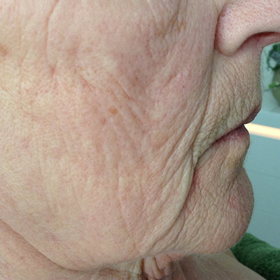 Seiten- und Halslift vorher