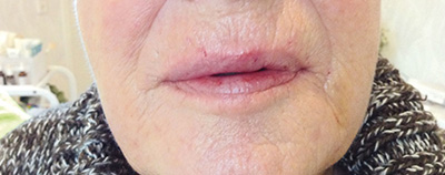 Unteres Softfacelift nachher