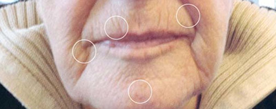 Unteres Softfacelift vorher