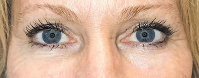 Unterlidstraffung nachher