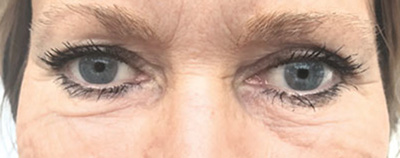Unterlidstraffung vorher